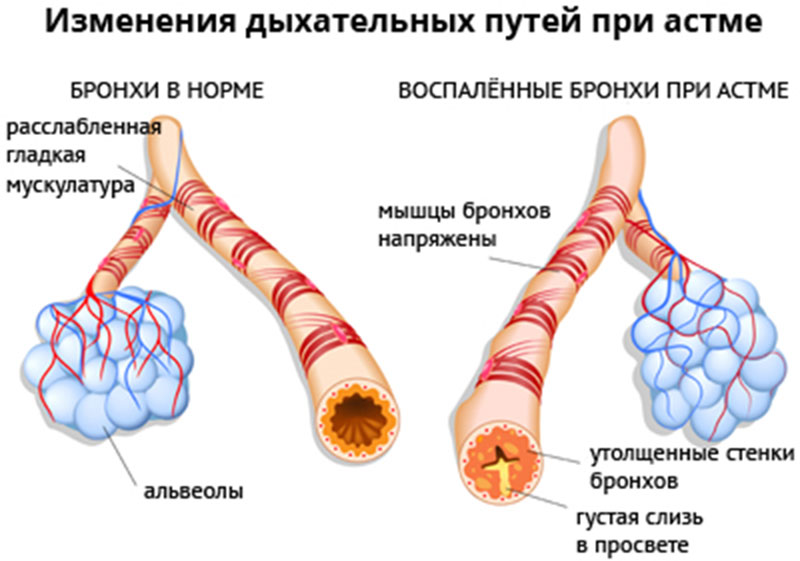 лечение астмы в клиники Блашенцева