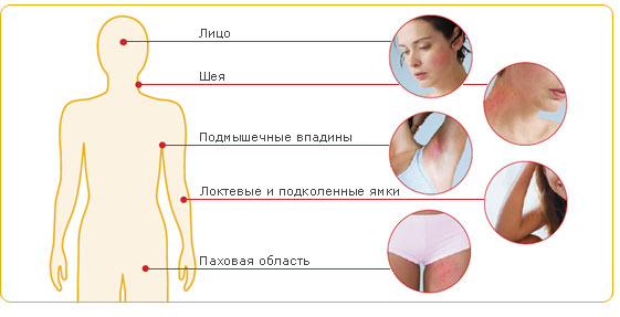 Атопический дерматит лечение в клинике Блашенцева
